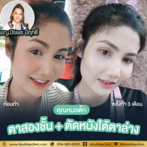 ตัดไขมันใต้ตา