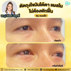 ตัดไขมันใต้ตา