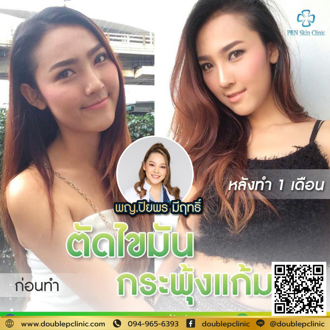 ตัดไขมันกระพุ้งแก้ม คือ