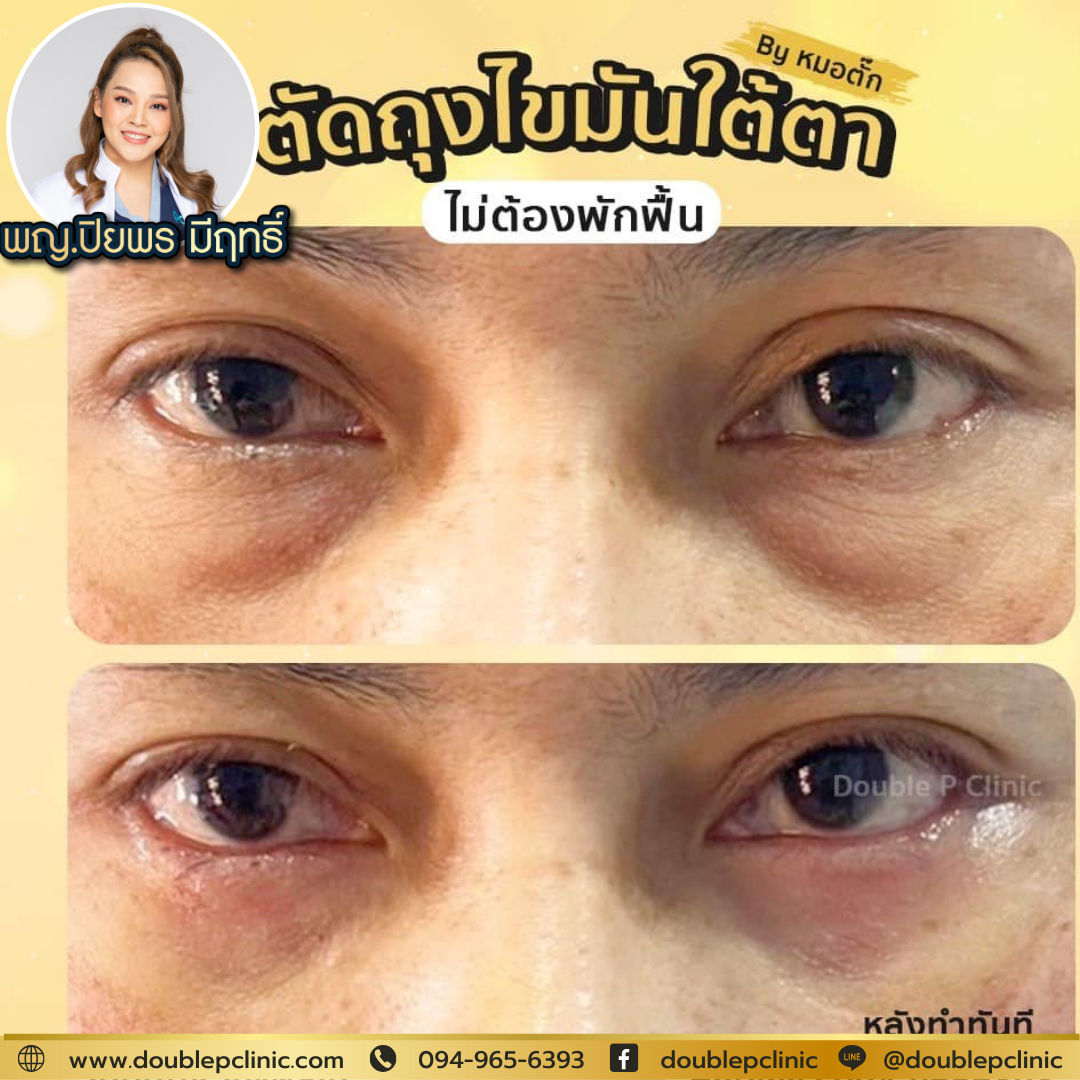 ตัดไขมันใต้ตา แผลใน คือ