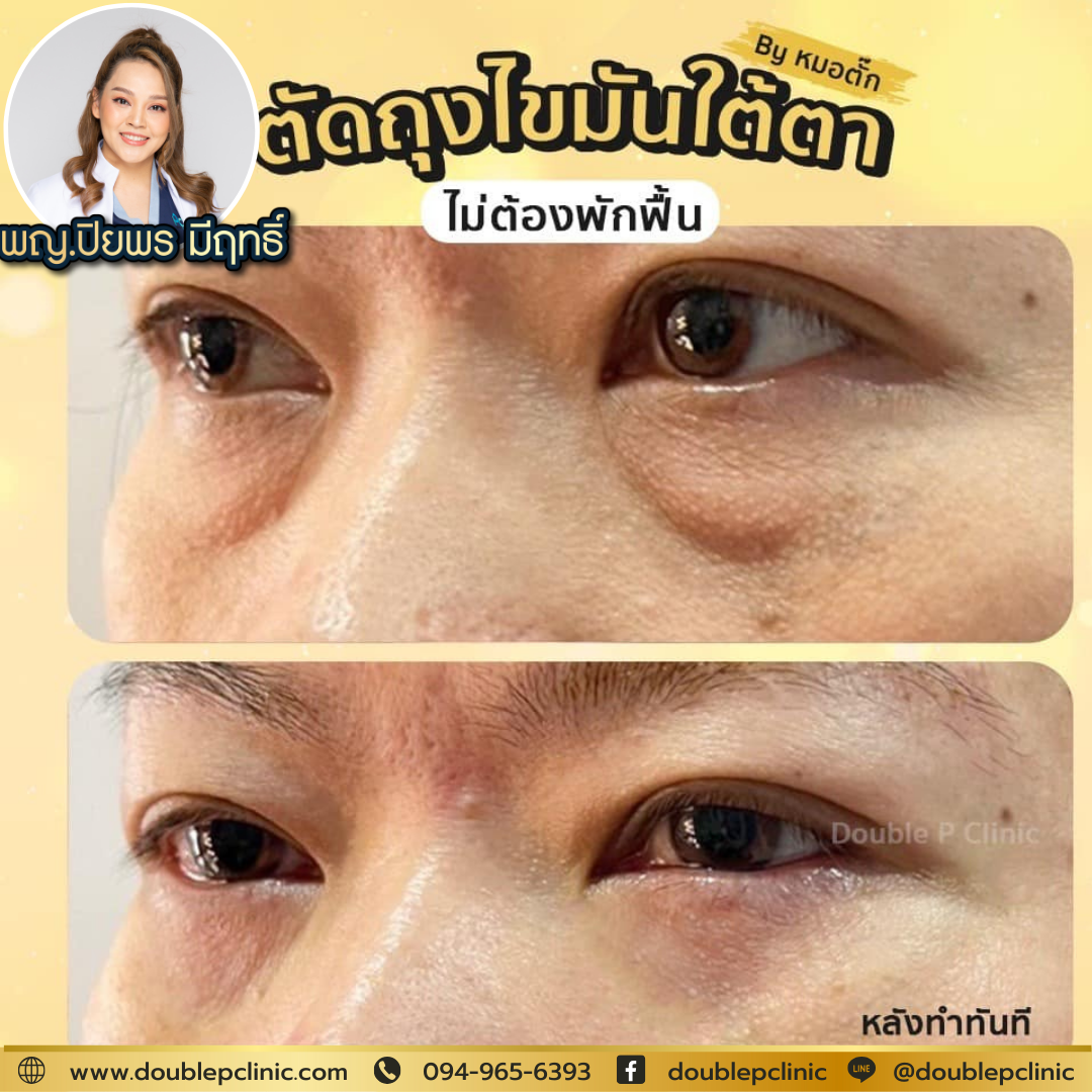 ผ่าตัดถุงไขมันใต้ตา