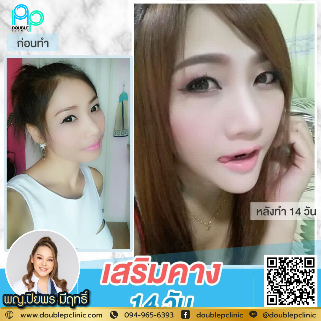 เสริมคาง Chin Augmentation