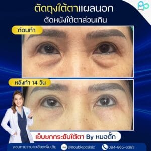 ตัดไขมันใต้ตา แผลใน