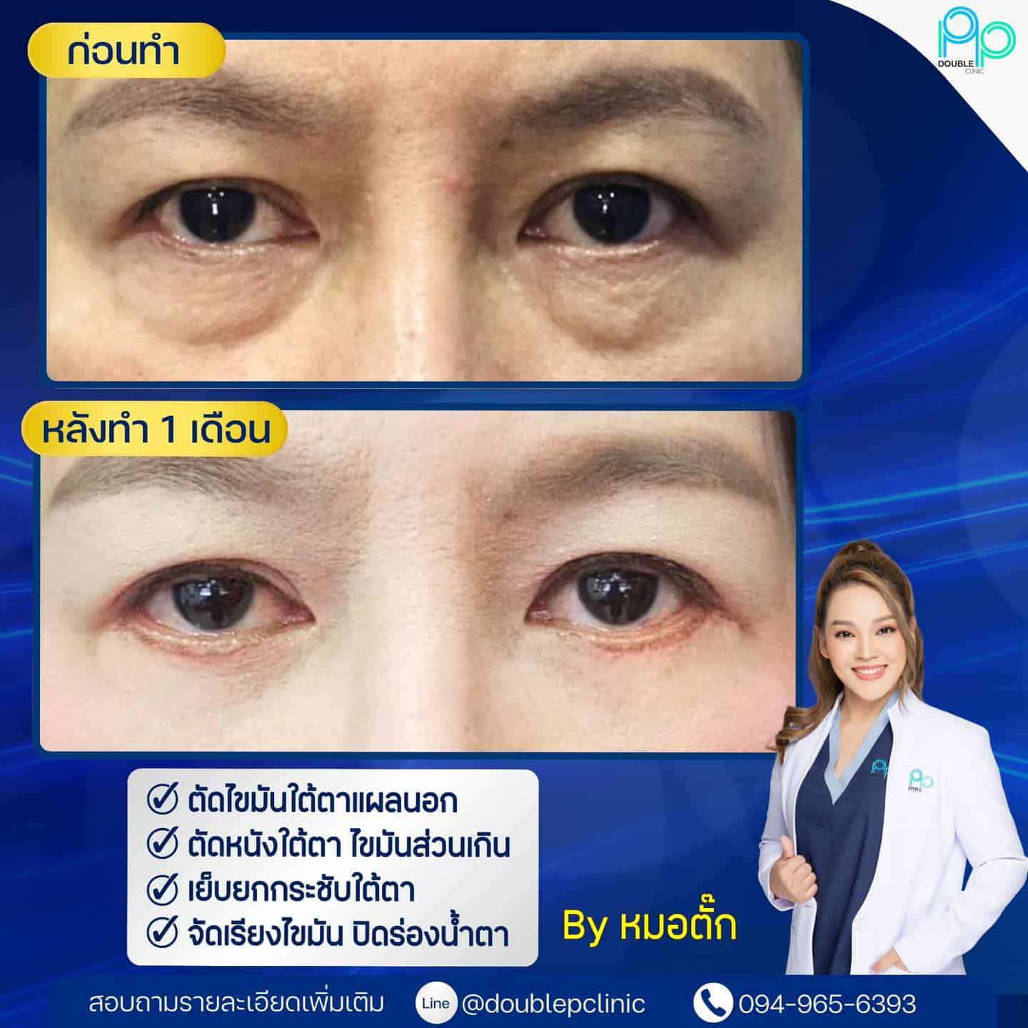 ใต้ตาบวม ผ่าตัดถุงไขมันใต้ตา ช่วยได้ไหม